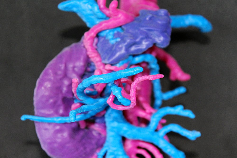 Our 3D printed models are widely used at IRCCS Policlinico San Matteo of Pavia to plan several surgical procedures.